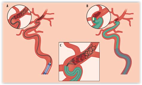 stroke suomeksi|Aivoinfarktin liuotushoito ja trombektomia käytännössä .